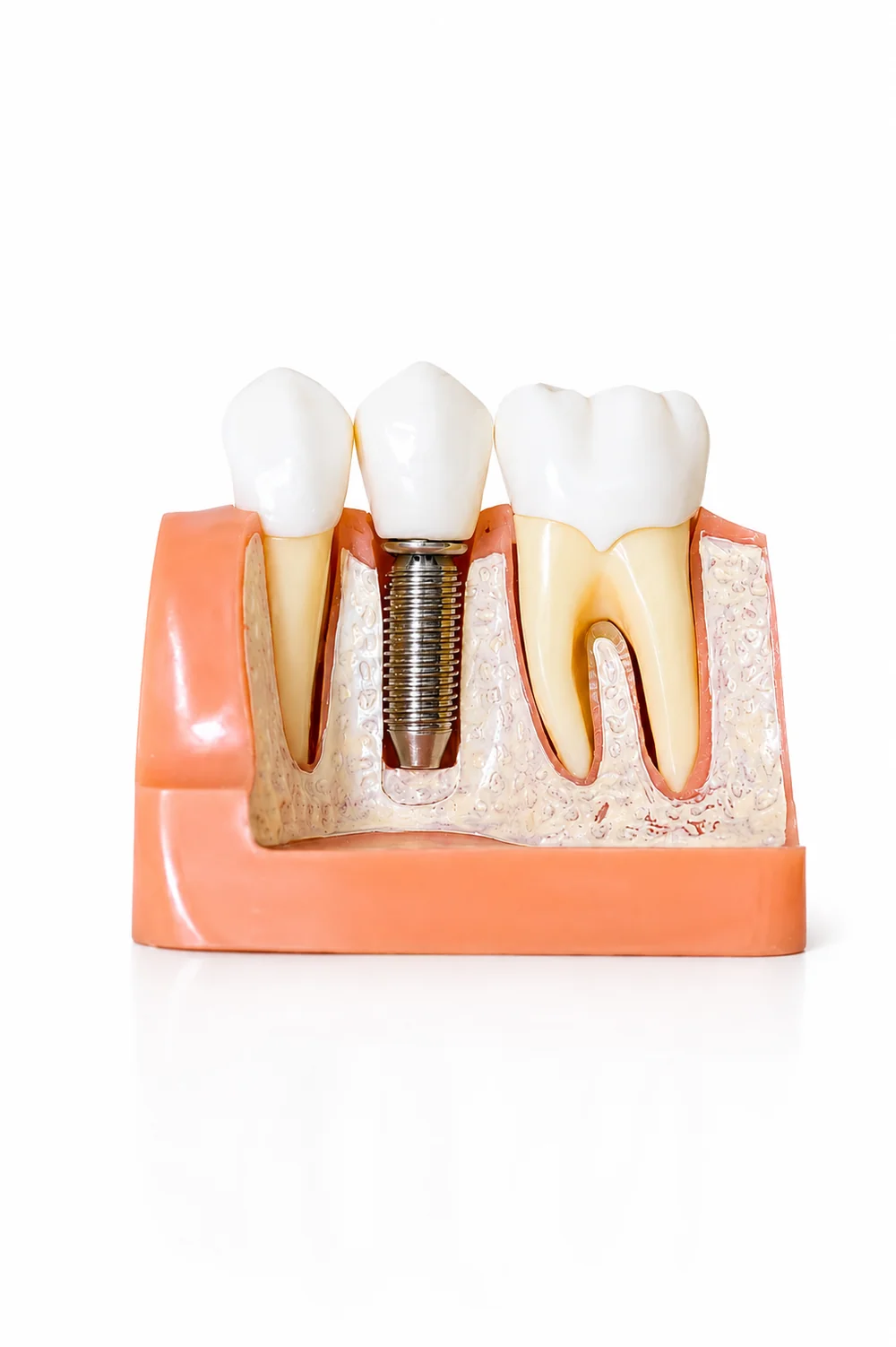 Modelo de implante dentário em corte